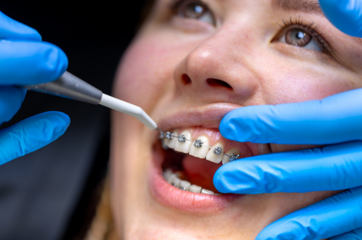 Orthodontic Treatment
