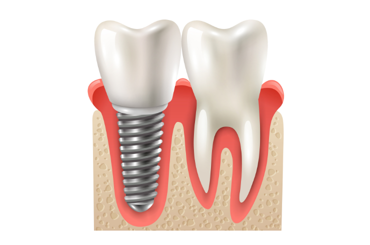Dental Implants